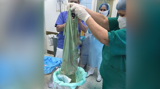 Απίστευτο: Ρώσοι γιατροί έκαναν καισαρική αλλά ξέχασαν... σεντόνι στην κοιλιά της μητέρας! (εικόνες)