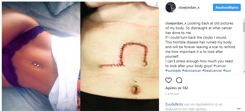 Πως μια αθώα selfie με μπικίνι στο Instagram έσωσε τη ζωή 21χρονης! (εικόνα)